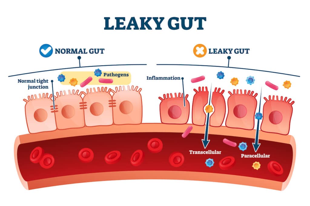 Cross-sectional graphic of intestinal cells in a normal healthy gut compared to a leaky gut