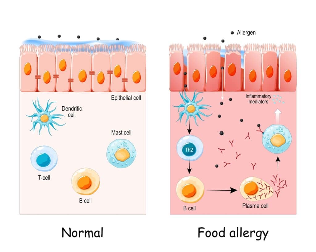 food allergy is an abnormal immune response to food. Cell of normal Epithelium and Food allergy. development of an allergic reaction from allergens penetration to Inflammatory mediators synthesis