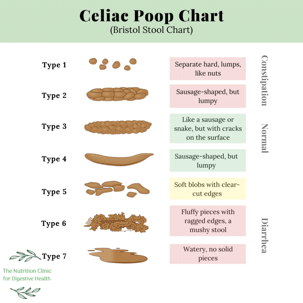 A chart depicting normal poop, as well as what classifies as diarrhea and constipation